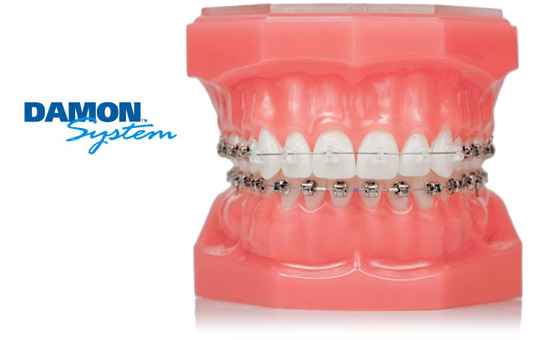 Most Affordable Damon Braces System in Dubai, Exclusively at Avance Dental