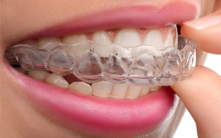 Best Invisible / Clear Aligner in Dubai by Avance Dental Clinic