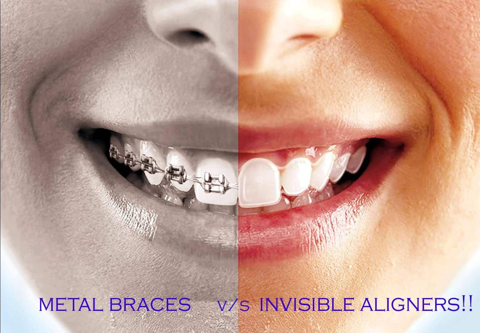 Metal Braces and Invisible Aligner comparison at Avance Dental