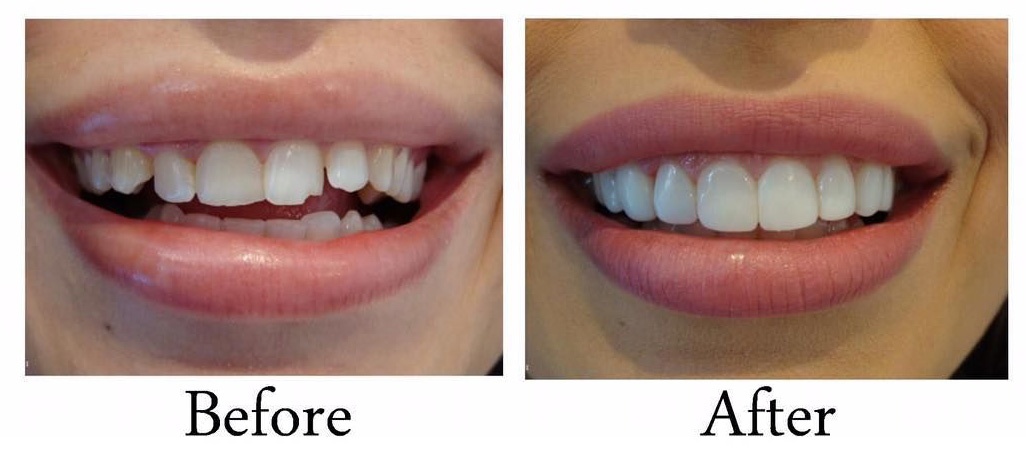 Best Dental Veneer - Before and After at Avance Dental Dubai